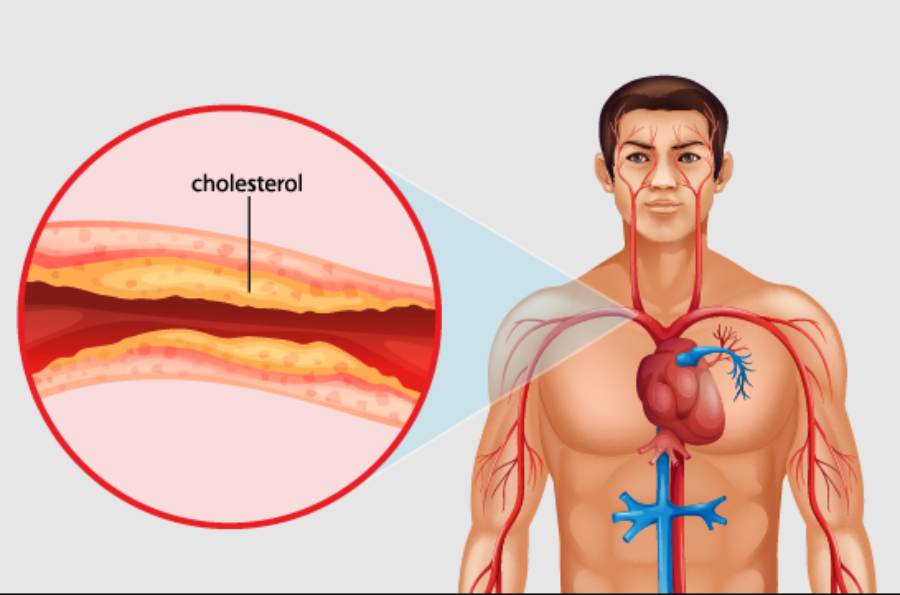 cholesterol