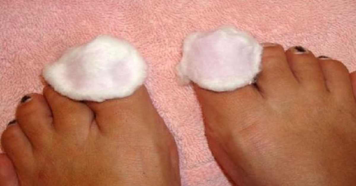 jak se zbavit plísně na nohou